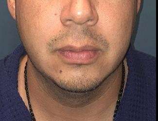 Facial Implants Before & After Patient #1403