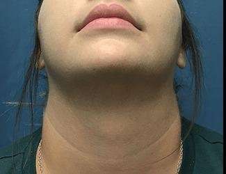Facial Implants Before & After Patient #1416