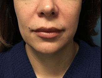 Facial Implants Before & After Patient #1464