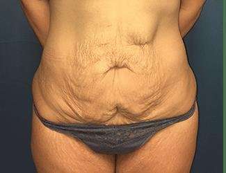 Tummy Tuck Before & After Patient #369