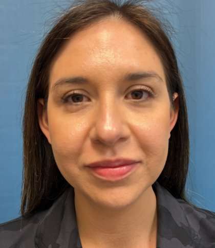 Facial Implants Before & After Patient #1486