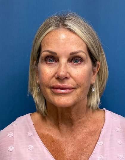 Facelift And Necklift Before & After Patient #1497