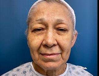 Facelift And Necklift Before & After Patient #1531