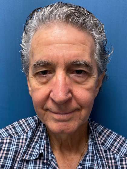 Facelift And Necklift Before & After Patient #1560