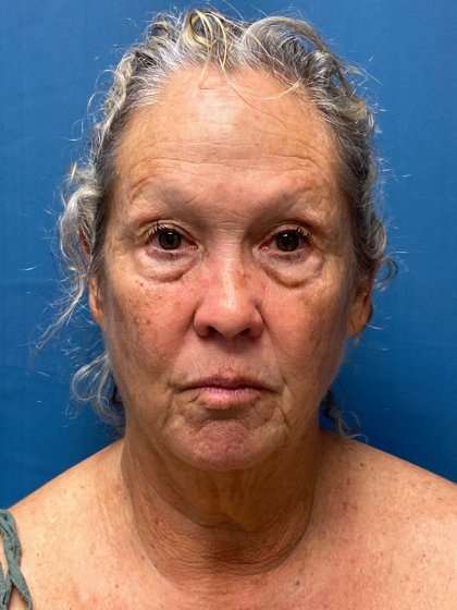 Facelift And Necklift Before & After Patient #1571