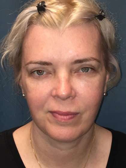 Facelift And Necklift Before & After Patient #1582