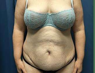 Tummy Tuck Before & After Patient #380