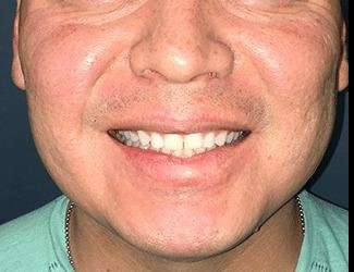 Buccal Fat Removal Before & After Patient #1656