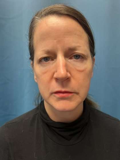 Brow Lift Before & After Patient #1674
