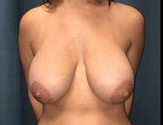 Breast Reduction Before & After Patient #1749