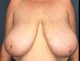 Breast Reduction Before & After Patient #1771