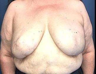 Breast Reduction Before & After Patient #1815
