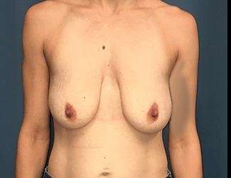 Breast Lift Before & After Patient #1923