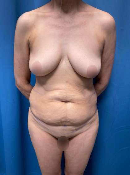 Tummy Tuck Before & After Patient #253