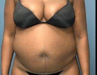 Tummy Tuck Before & After Patient #528