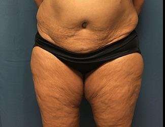 Lower Body Lift Before & After Patient #1047