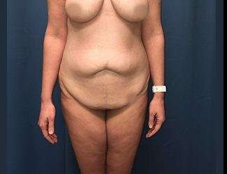 Lower Body Lift Before & After Patient #1114