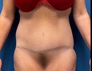 Lower Body Lift Before & After Patient #1127