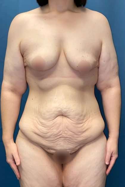 Lower Body Lift Before & After Patient #1187