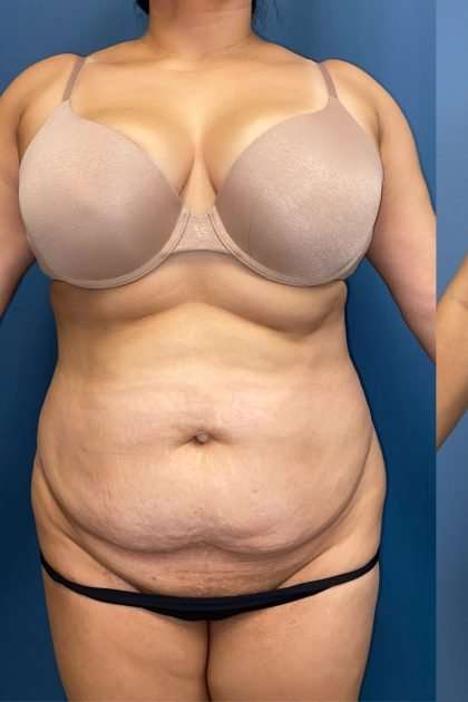 Lower Body Lift Before & After Patient #1213
