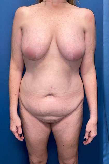 Lower Body Lift Before & After Patient #1239