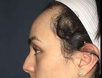 Forehead Reduction Before & After Patient #1364