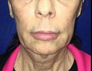 Facial Implants Before & After Patient #1392