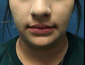Facial Implants Before & After Patient #1416