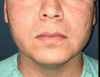 Buccal Fat Removal Before & After Patient #1656