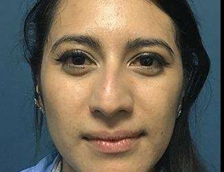Rhinoplasty Before & After Patient #667
