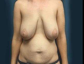 Breast Lift Before & After Patient #1978