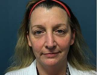 Blepharoplasty Before & After Patient #2308