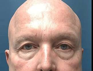 Blepharoplasty Before & After Patient #2328