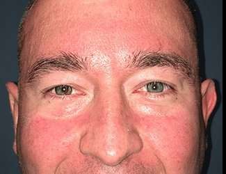 Blepharoplasty Before & After Patient #2352