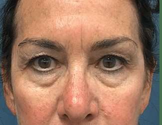Blepharoplasty Before & After Patient #2368