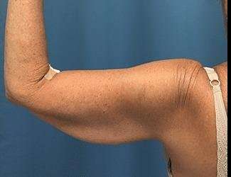 Arm Lift Before & After Patient #2461