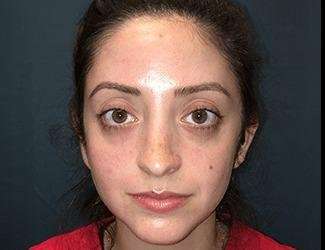 Rhinoplasty Before & After Patient #680