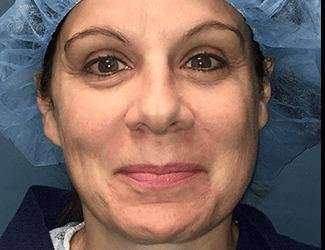 Rhinoplasty Before & After Patient #693