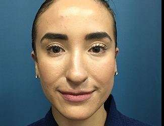 Rhinoplasty Before & After Patient #706