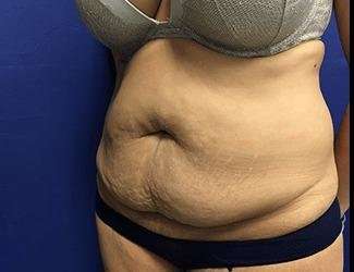 Tummy Tuck Before & After Patient #395