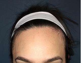 Forehead Reduction Before & After Patient #1364