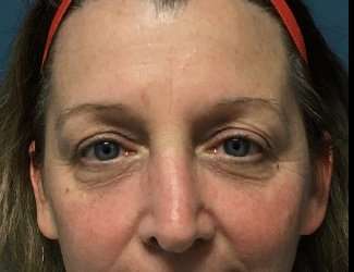 Blepharoplasty Before & After Patient #2308