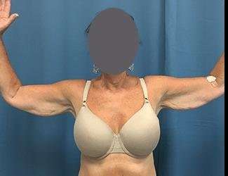 Arm Lift Before & After Patient #2461