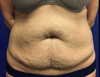 Tummy Tuck Before & After Patient #395