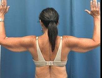 Arm Lift Before & After Patient #2461