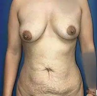 Before and After