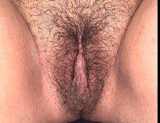Labiaplasty Before & After Patient #2772
