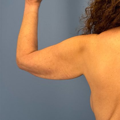 Arm Lift Before & After Patient #3150