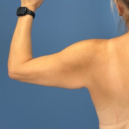 Arm Lift Before & After Patient #3151