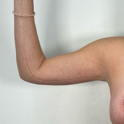Arm Lift Before & After Patient #3151
